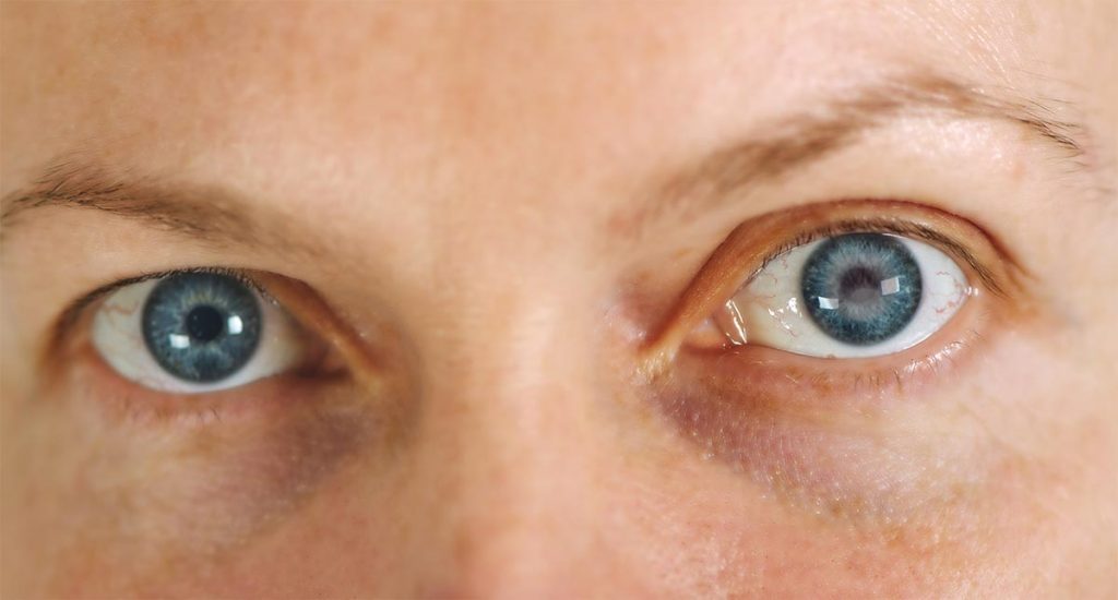 Cataratas en los ojos: qué son y cómo se producen