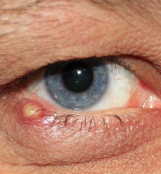 Como curar un orzuelo