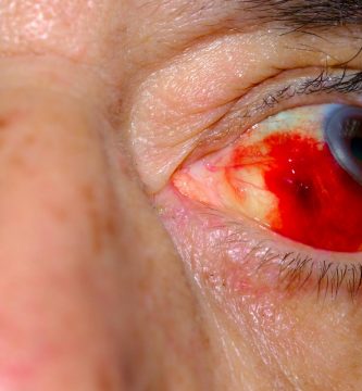 derrame ocular Ojo humano / fotografía de ojos / cuidar los ojos