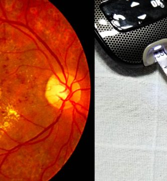 retinopatia-diabetica