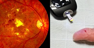 retinopatia-diabetica