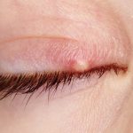 chalazion