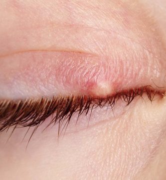 chalazion