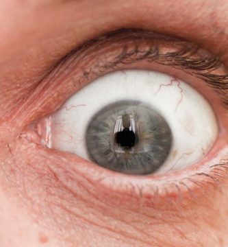 exoftalmia-ojos-saltones Ojo humano / fotografía de ojos / cuidar los ojos