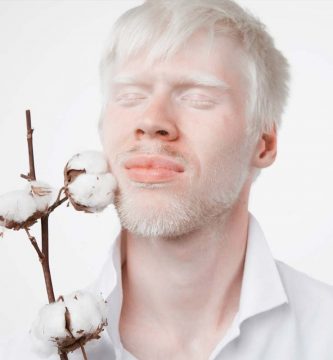 problemas-oculares-de-las-personas-albinas