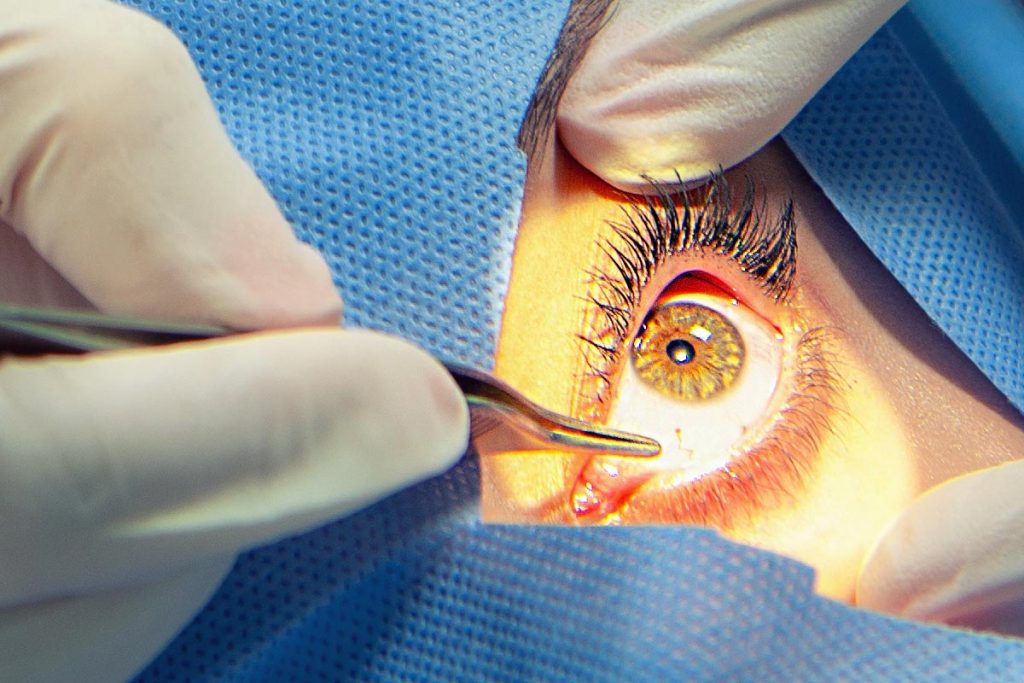 lava Orador Mediador Qué son los lentes intraoculares? Como Cuidar Los Ojos