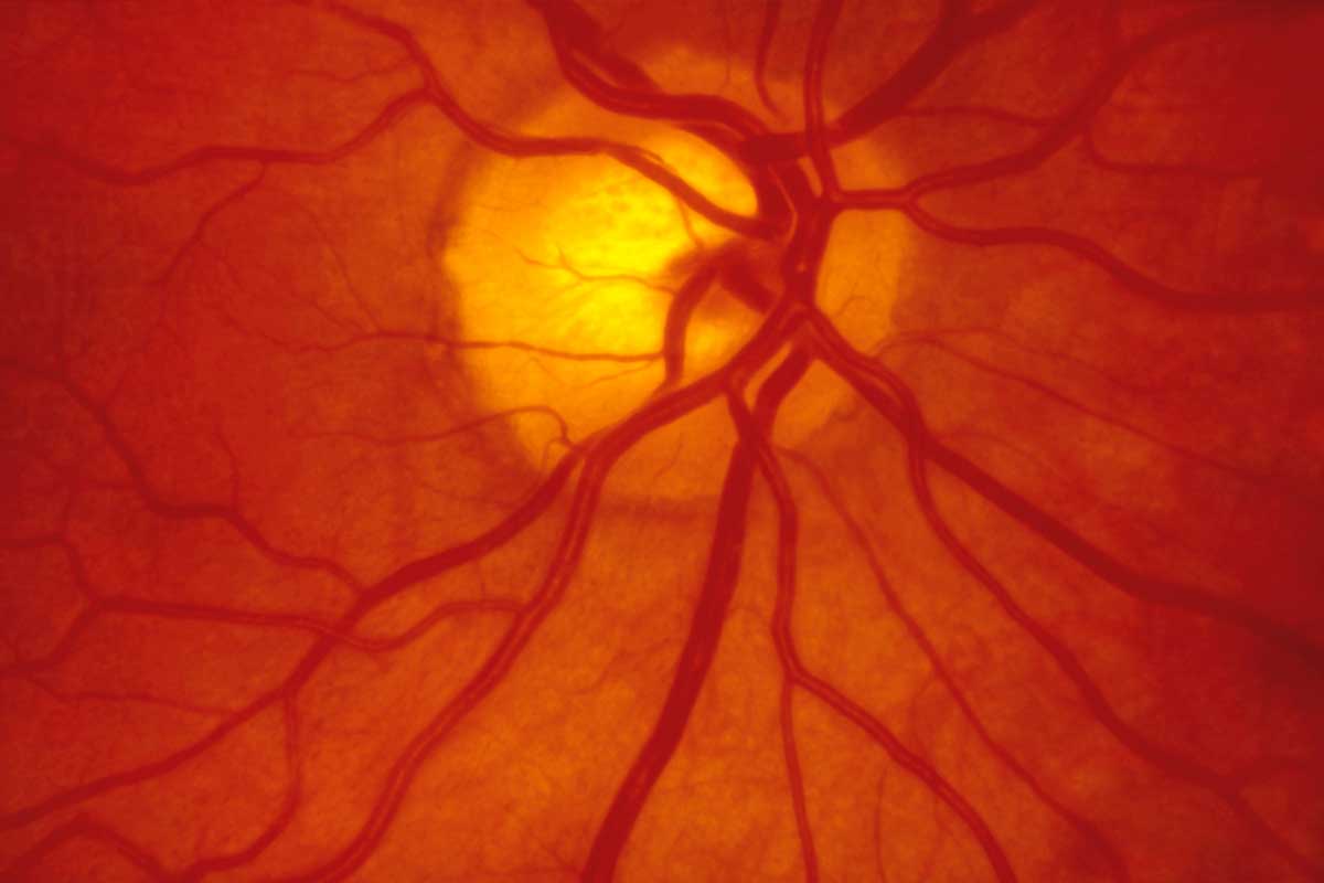 por-que-se-desprende-la-retina Ojo humano / fotografía de ojos / cuidar los ojos
