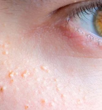 quistes de milium Ojo humano / fotografía de ojos / cuidar los ojos