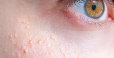 quistes de milium Ojo humano / fotografía de ojos / cuidar los ojos