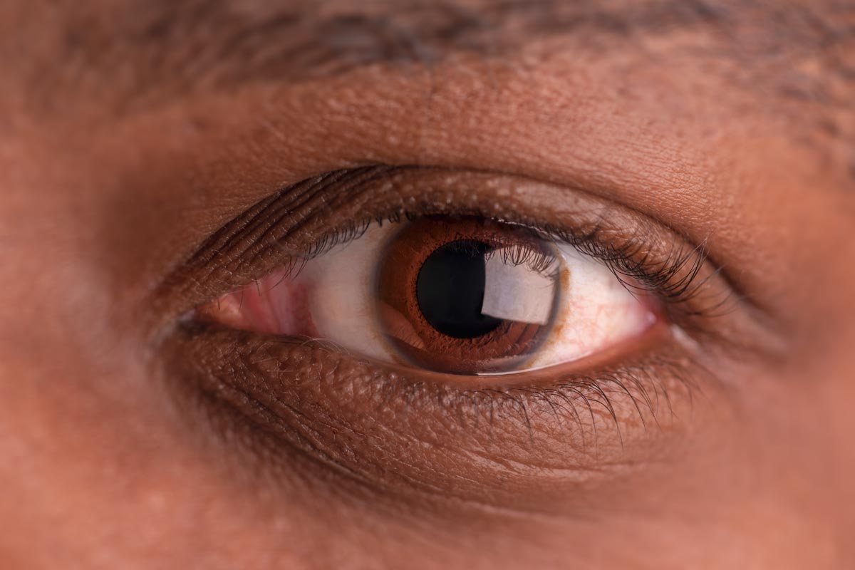vitrectomía Ojo humano / fotografía de ojos / cuidar los ojos