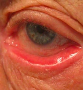 ectropion Ojo humano / fotografía de ojos / cuidar los ojos