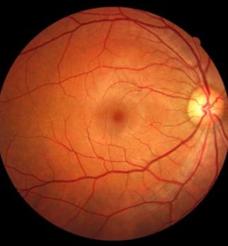 Problemas dr la retina FOTO: www.associatedeyecare.com Ojo humano / fotografía de ojos / cuidar los ojos