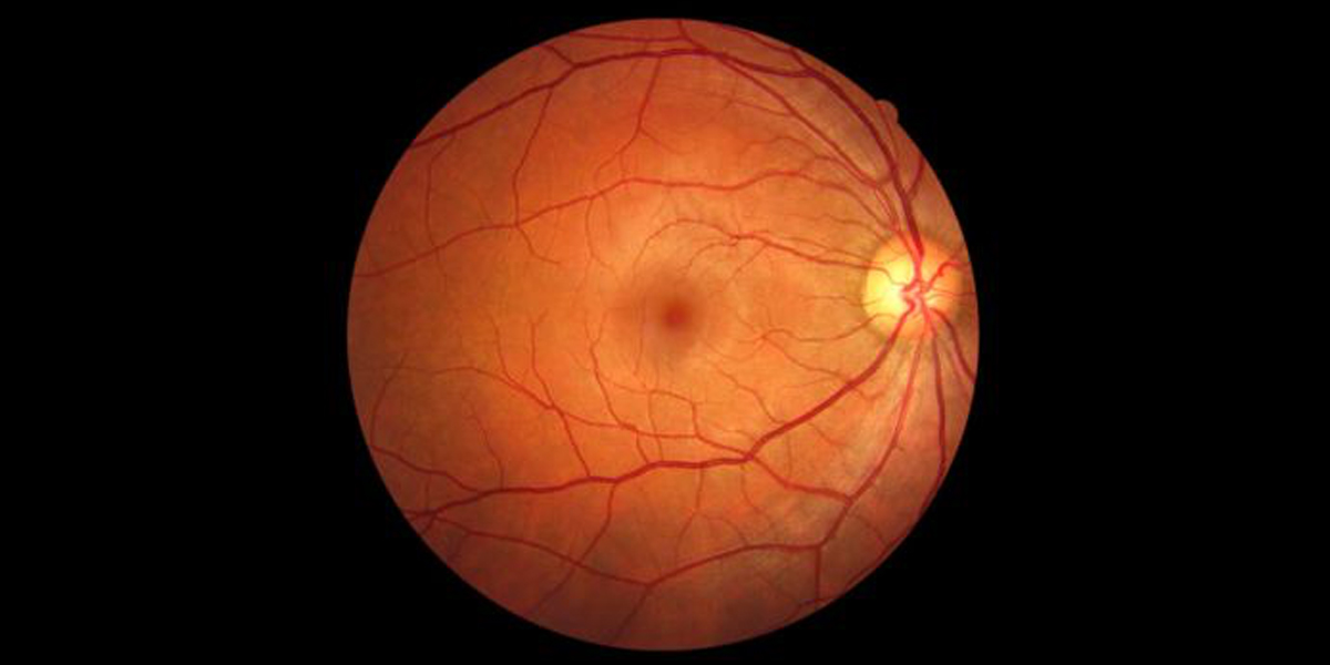Problemas dr la retina FOTO: www.associatedeyecare.com Ojo humano / fotografía de ojos / cuidar los ojos