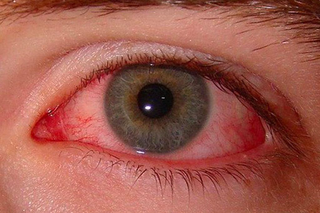 prevenir-la-conjuntivitis -ojos rojos