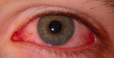 prevenir-la-conjuntivitis -ojos rojos