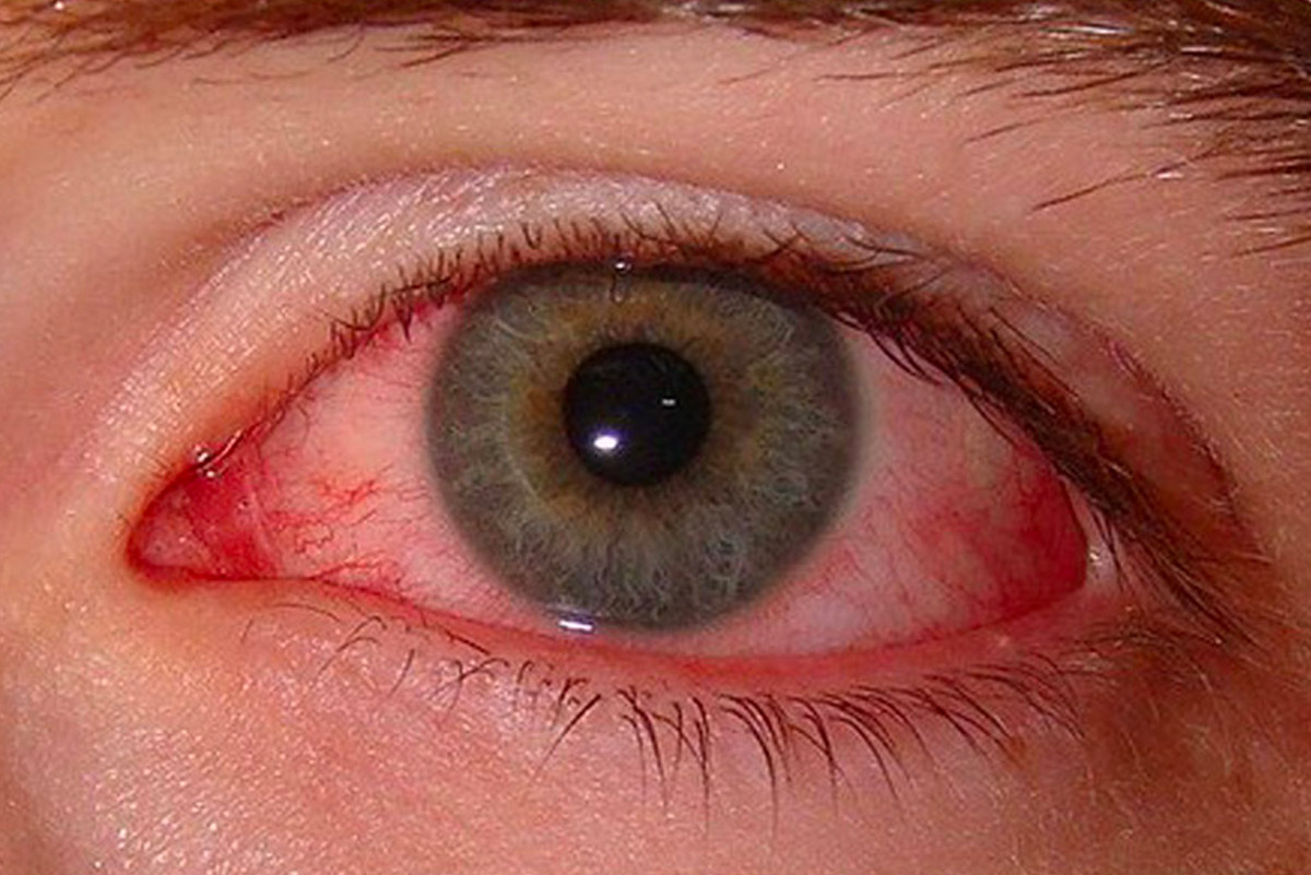 prevenir-la-conjuntivitis -ojos rojos / Ojo humano / fotografía de ojos / cuidar los ojos
