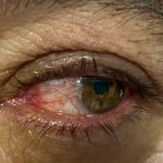 pterigión Galería enfermedades de los ojos