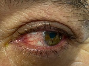 pterigión Galería enfermedades de los ojos