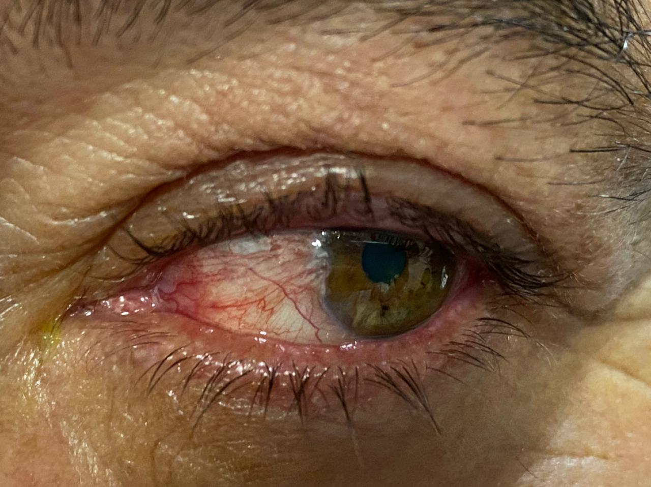 pterigi贸n Galer铆a enfermedades de los ojos Ojo humano / fotograf铆a de ojos / cuidar los ojos