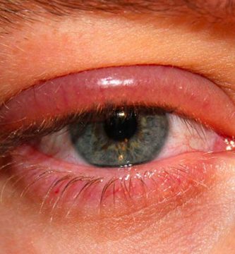 que-es-la-blefaritis Ojo humano / fotografía de ojos / cuidar los ojos