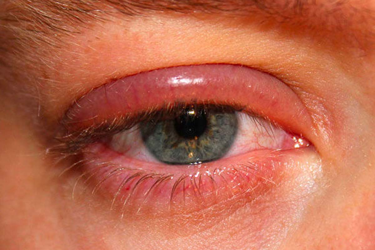 que-es-la-blefaritis Ojo humano / fotografía de ojos / cuidar los ojos