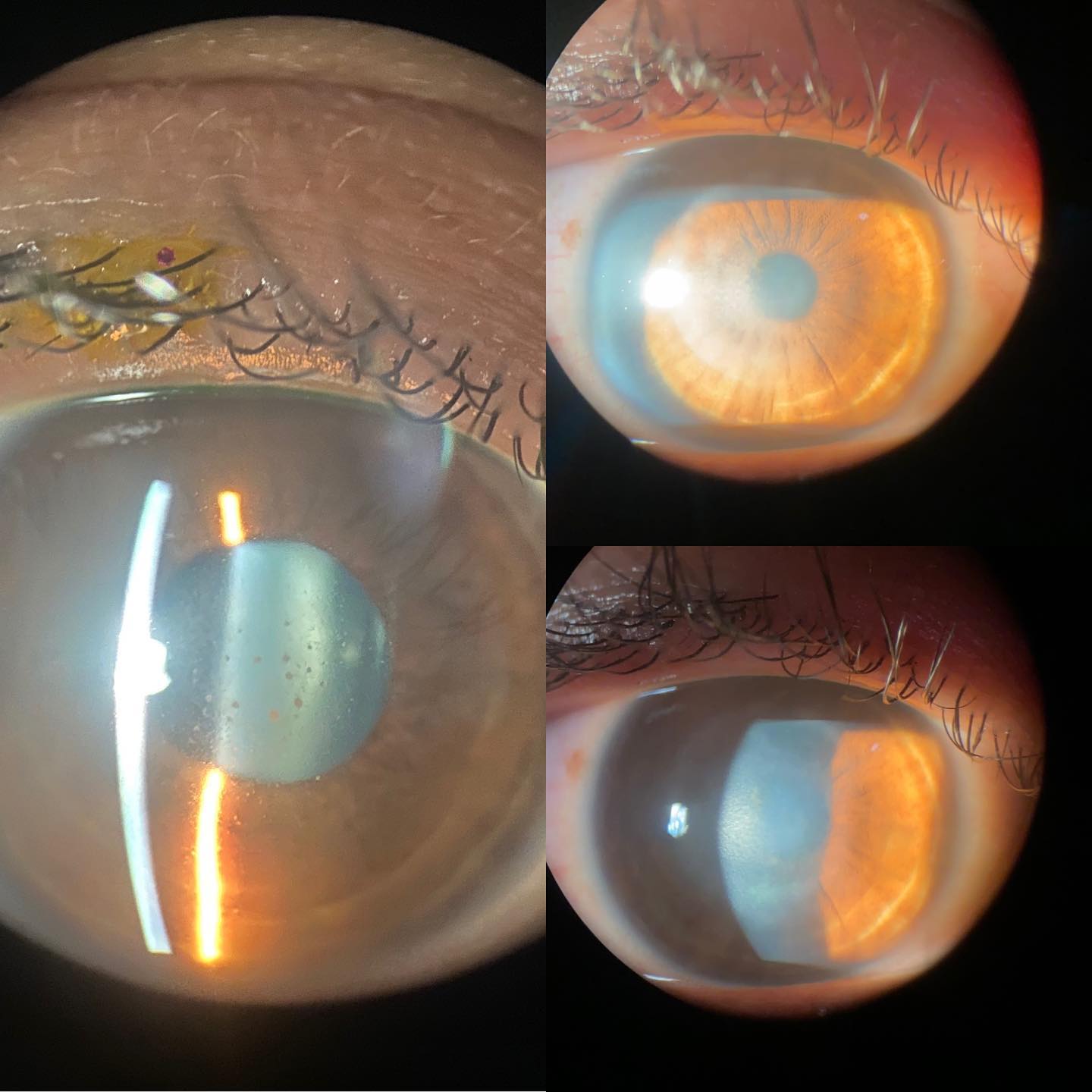 queratouveitis herpetica y leucona residual Ojo humano / fotografía de ojos / cuidar los ojos