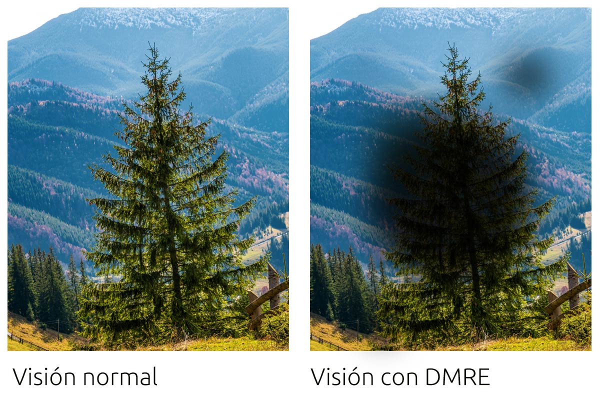 Visión normal y la misma imagen vista con Degeneración Macular Relacionada con la Edad (DMRE)