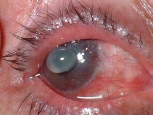 Luxación espontánea del cristalino en paciente con #glaucoma neovascular terminal quien sufre perforación de su córnea también espontánea .