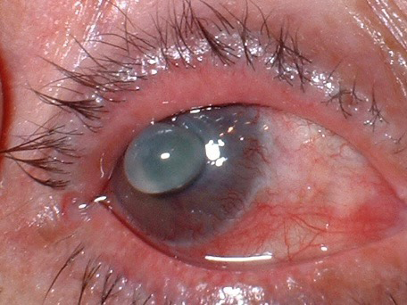 Cristalino visible debido a perforación de la córnea por glaucoma. 