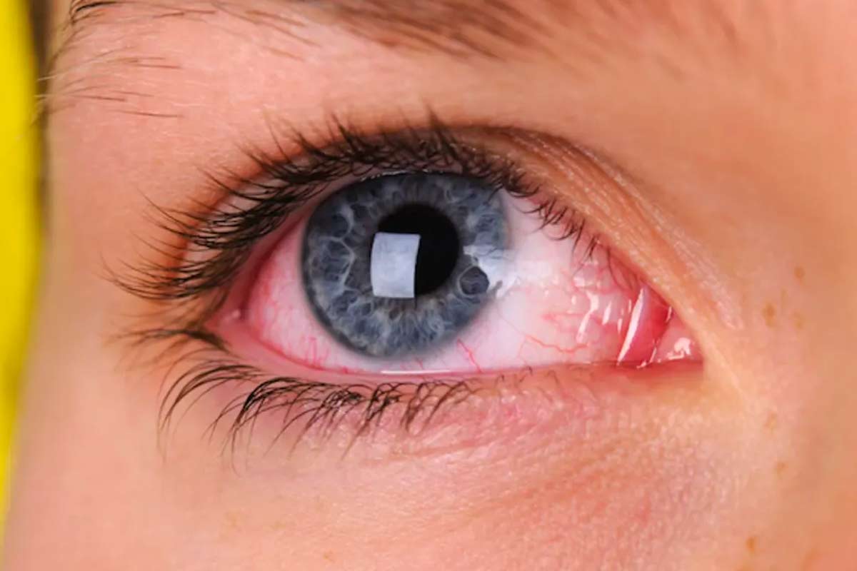 rosacea-ocular / Ojo humano / fotografía de ojos / cuidar los ojos