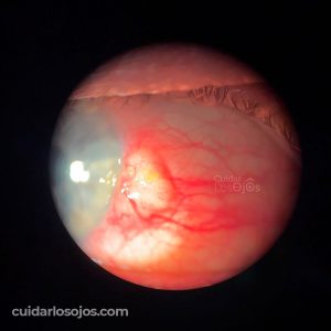 tratar-la-pinguecula / Ojo humano / fotograf&iacute;a de ojos / cuidar los ojos