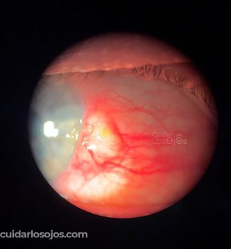 tratar-la-pinguecula / Ojo humano / fotografía de ojos / cuidar los ojos