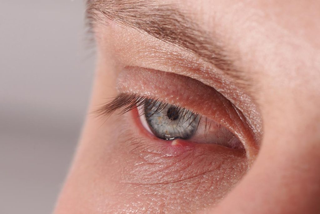 chalazion bulto en el parpado