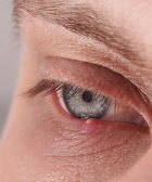 chalazion bulto en el parpado