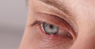 chalazion bulto en el parpado