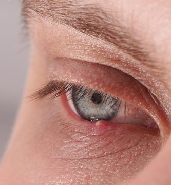 chalazion bulto en el parpado