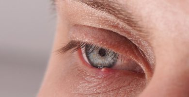 chalazion bulto en el parpado