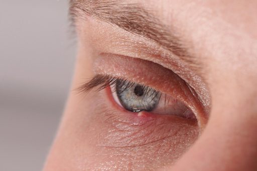 chalazion bulto en el parpado