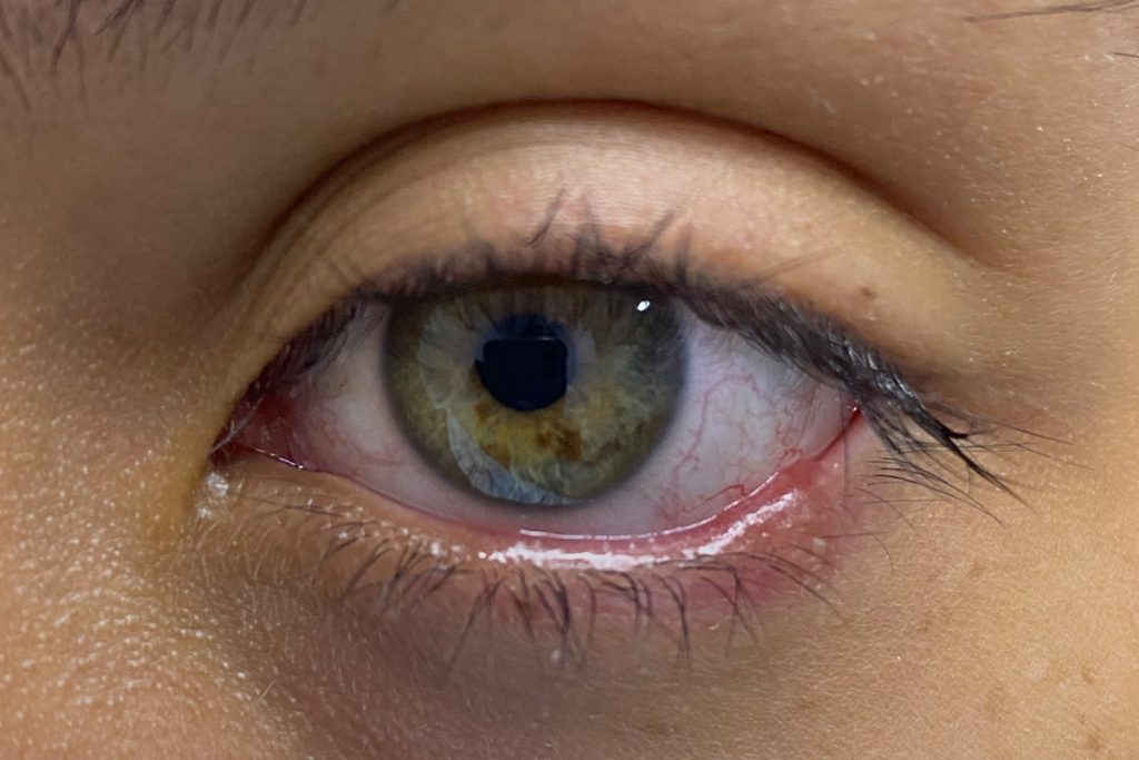 blefaritis-dra-vanessa-vidal-oftalmologa