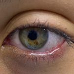 blefaritis-dra-vanessa-vidal-oftalmologa