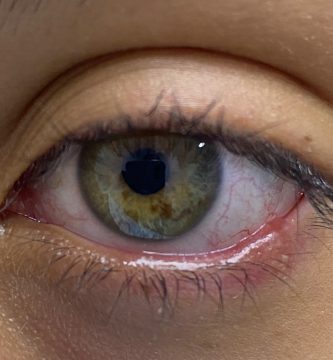 blefaritis-dra-vanessa-vidal-oftalmologa