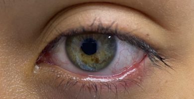 blefaritis-dra-vanessa-vidal-oftalmologa