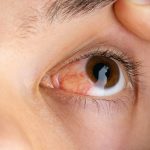 ojo de una persona con pterigion