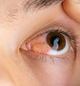 ojo de una persona con pterigion