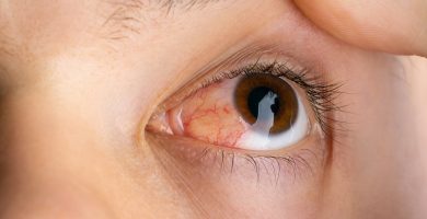 ojo de una persona con pterigion
