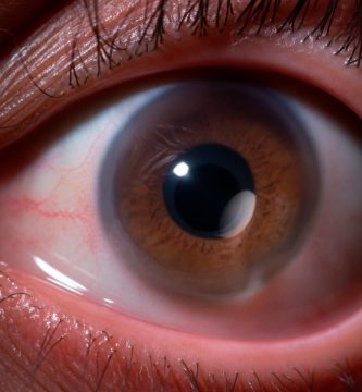 primer-plano-de-ojo-con-queratocono