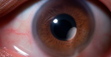 primer-plano-de-ojo-con-queratocono