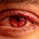 primer-plano-de-un-ojo-sindrome-de-ojos-secos